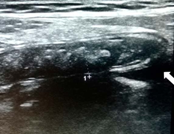 Алгоритм ультразвуковой диагностики острого аппендицита			     
        Алгоритм ультразвуковой диагностики острого аппендицита