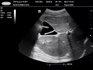 
			Аномалии развития билиарного тракта у детей и их клинико-патогенетическое значение		