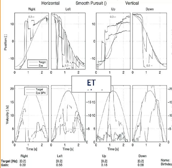Периферический вестибулярный синдром
Периферический вестибулярный синдром
