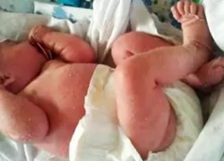 
			Ранняя диагностика тяжелых комбинированных иммунодефицитов		