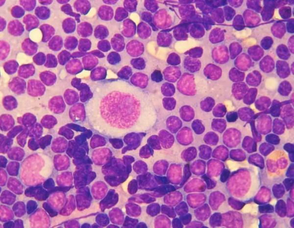 Лимфома Ходжкина у детей и подростков		 
			Лимфома Ходжкина у детей и подростков