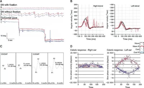 Периферический вестибулярный синдром
Периферический вестибулярный синдром