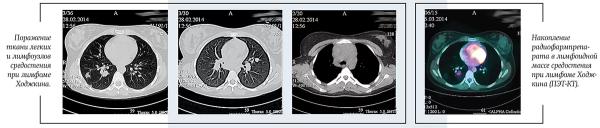 Лимфома Ходжкина у детей и подростков		 
			Лимфома Ходжкина у детей и подростков