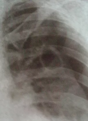 О терапии деструктивных форм туберкулеза легких 		 
			О терапии деструктивных форм туберкулеза легких