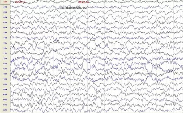 
			Пароксизмальные состояния у детей неэпилептического характера		