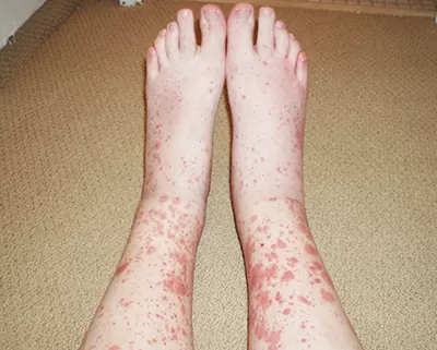 
			Дерматологические осложнения COVID-19 и тактика ведения пациентов с заболеваниями кожи		