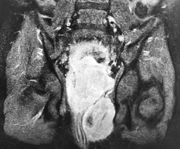 Нейрогенный мочевой пузырь		 
			Нейрогенный мочевой пузырь