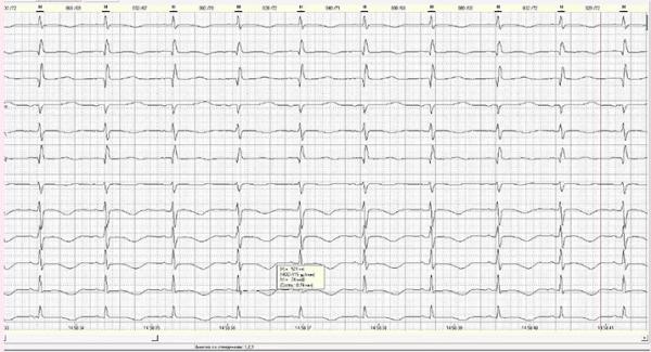 Диагностика врожденного синдрома  удлиненного интервала QT		 
			Диагностика врожденного синдрома  удлиненного интервала QT