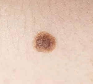 
			 О важности ранней диагностики меланомы кожи		