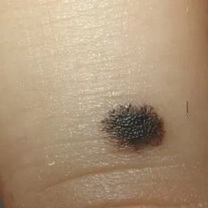 
			 О важности ранней диагностики меланомы кожи		