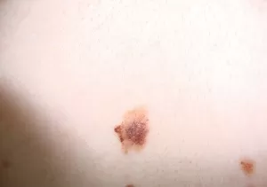 
			 О важности ранней диагностики меланомы кожи		