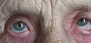 Лечение слезотечения. Часть 2
Лечение слезотечения. Часть 2