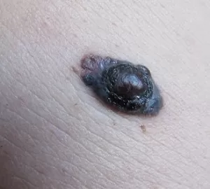 
			 О важности ранней диагностики меланомы кожи		