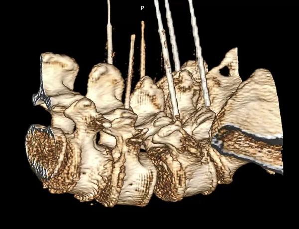 Фасеточный синдром: радиочастотная денервация фасеточных суставов		 
			Фасеточный синдром: радиочастотная денервация фасеточных суставов