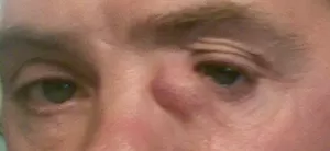 Лечение слезотечения. Часть 2
Лечение слезотечения. Часть 2