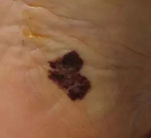 
			 О важности ранней диагностики меланомы кожи		