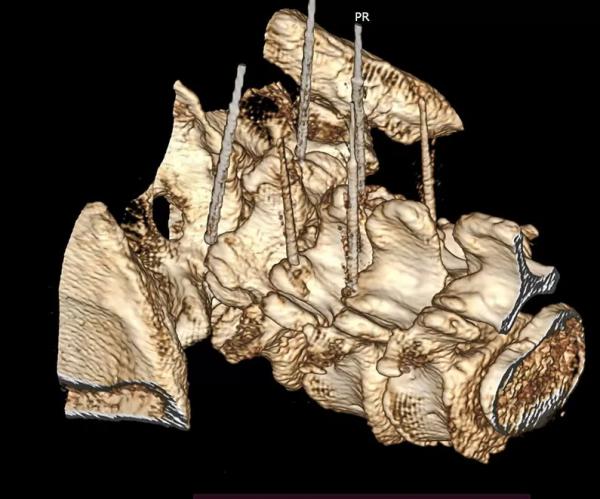 Фасеточный синдром: радиочастотная денервация фасеточных суставов		 
			Фасеточный синдром: радиочастотная денервация фасеточных суставов