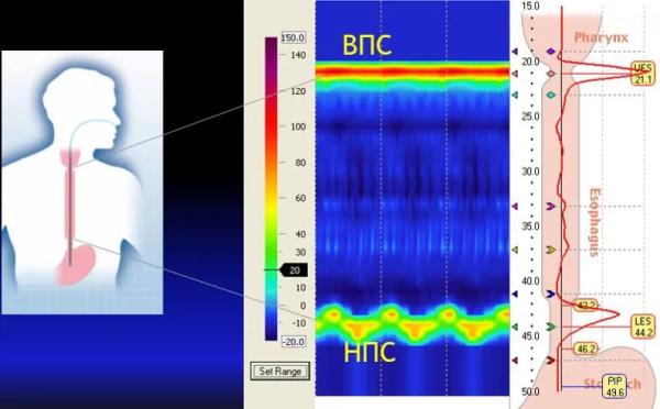 Манометрия пищевода высокого разрешения		 
			Манометрия пищевода высокого разрешения