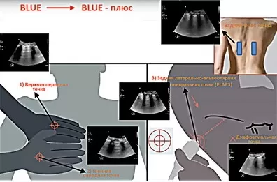 
			УЗИ легких у пациентов с CoViD-19: характерные признаки поражения и их клиническая значимость. Часть 2		