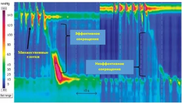 Манометрия пищевода высокого разрешения		 
			Манометрия пищевода высокого разрешения