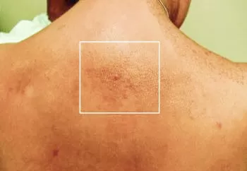 Онкоэндокринология: синдром множественной эндокринной неоплазии 2А типа		 
			Онкоэндокринология: синдром множественной эндокринной неоплазии 2А типа