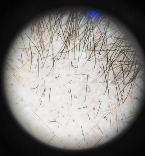 COVID-19 и выпадение волос
COVID-19 и выпадение волос