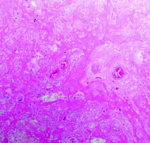 
			Патология плаценты при COVID-19		