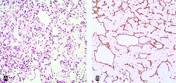 Опухоль в сердце: сложности диагностики и хирургии		 
			Опухоль в сердце: сложности диагностики и хирургии
