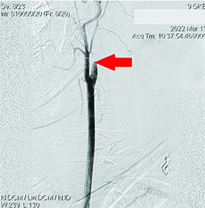 Острый ишемический инсульт у подростка: опыт комбинированного внутрисосудистого тромболизиса
Острый ишемический инсульт у подростка: опыт комбинированного внутрисосудистого тромболизиса