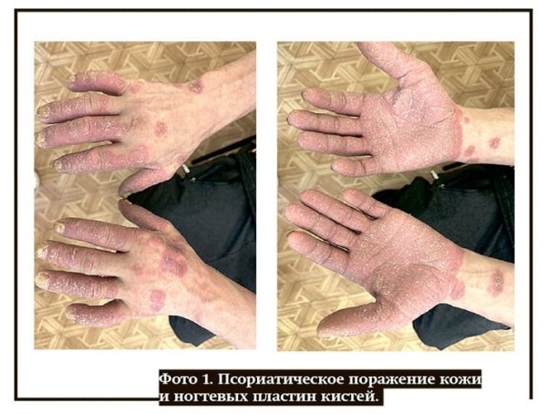 
        Нефропатия у пациента с псориазом			    