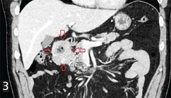 Гастроинтестинальные стромальные опухоли: взгляд рентгенолога
Гастроинтестинальные стромальные опухоли: взгляд рентгенолога