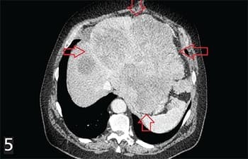 Гастроинтестинальные стромальные опухоли: взгляд рентгенолога
Гастроинтестинальные стромальные опухоли: взгляд рентгенолога