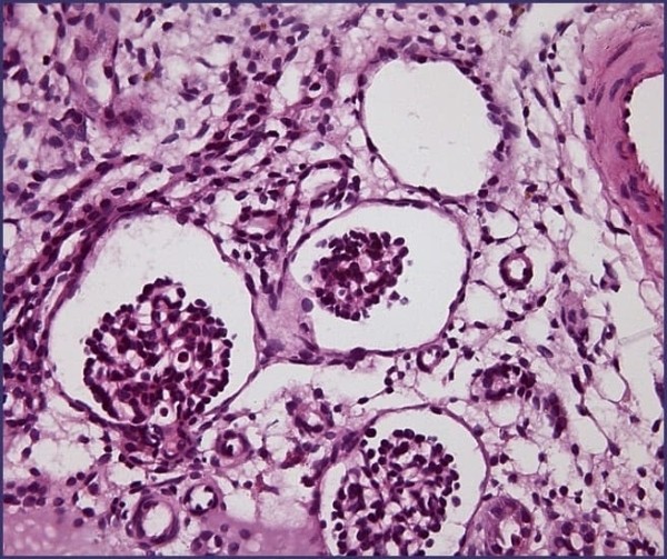 Морфологическая диагностика в детской нефрологии			     
        Морфологическая диагностика в детской нефрологии