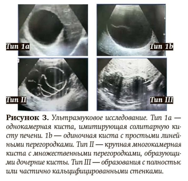 Эхинококкоз: как избежать послеоперационных рецидивов			     
        Эхинококкоз: как избежать послеоперационных рецидивов