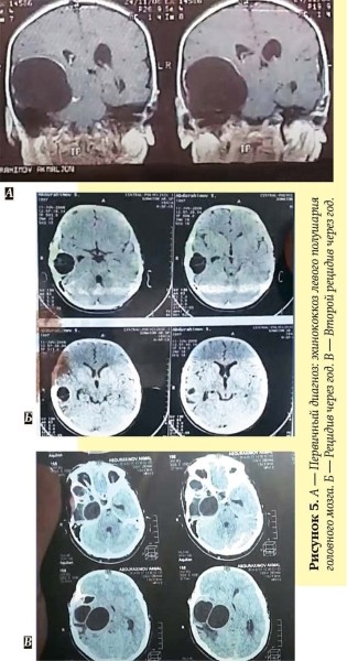 Эхинококкоз: как избежать послеоперационных рецидивов			     
        Эхинококкоз: как избежать послеоперационных рецидивов