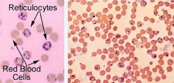Гемолитические анемии у детей: клиника и алгоритм диагностики			     
        Гемолитические анемии у детей: клиника и алгоритм диагностики