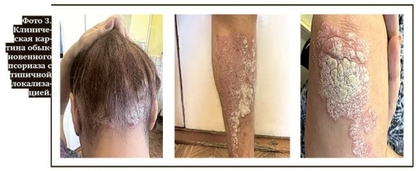 
        Нефропатия у пациента с псориазом			    