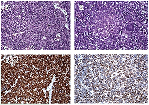 Cаркома опорно-двигательного аппарата у детей. Молекулярно-генетическая диагностика
Cаркома опорно-двигательного аппарата у детей. Молекулярно-генетическая диагностика
