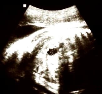 
        Обструкция верхних отделов мочевыводящей системы у плода. Клинический случай			    