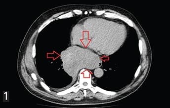 Гастроинтестинальные стромальные опухоли: взгляд рентгенолога
Гастроинтестинальные стромальные опухоли: взгляд рентгенолога