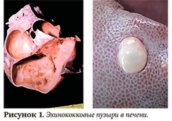 Эхинококкоз: как избежать послеоперационных рецидивов			     
        Эхинококкоз: как избежать послеоперационных рецидивов