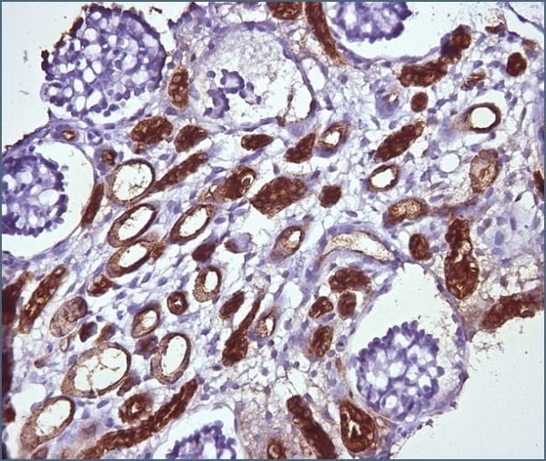 Морфологическая диагностика в детской нефрологии			     
        Морфологическая диагностика в детской нефрологии