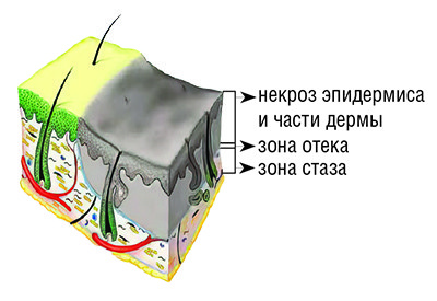 Ожоги: принципы диагностики и выбор тактики лечения. Часть 1 + аудио
Ожоги: принципы диагностики и выбор тактики лечения. Часть 1 + аудио