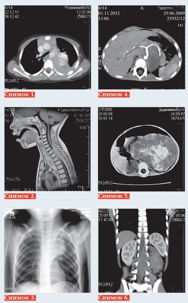 Нейробластома у детей: пути снижения запущенных случаев			     
        Нейробластома у детей: пути снижения запущенных случаев