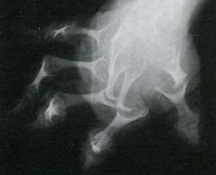 
        Псориатический артрит: диагностика и тактика ведения пациента			    