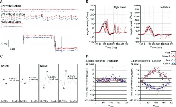 Периферический вестибулярный синдром			     
        Периферический вестибулярный синдром