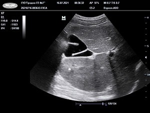 
        Аномалии развития билиарного тракта у детей и их клинико-патогенетическое значение + аудио			
        
        