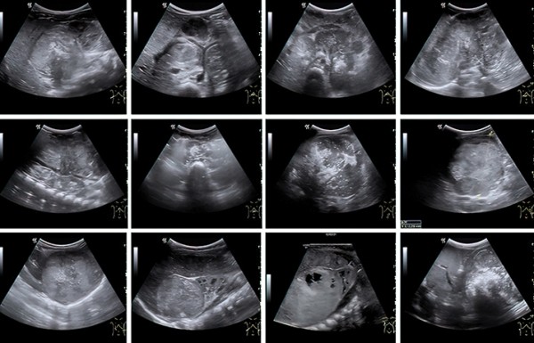 Нейробластома у детей: пути снижения запущенных случаев			     
        Нейробластома у детей: пути снижения запущенных случаев