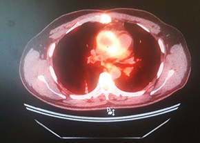 
        ПЭТ в диагностике воспалительных изменений после кардиохирургических вмешательств			    