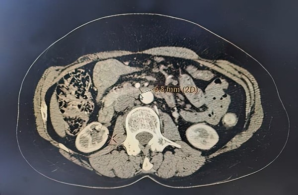 Лапароскопический дуоденоэнтероанастомоз при синдроме верхней брыжеечной артерии			     
        Лапароскопический дуоденоэнтероанастомоз при синдроме верхней брыжеечной артерии